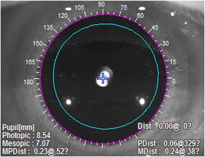 Presbyopia-correcting performance and subjective outcomes of a trifocal intraocular lens in eyes with different axial lengths: A prospective cohort study